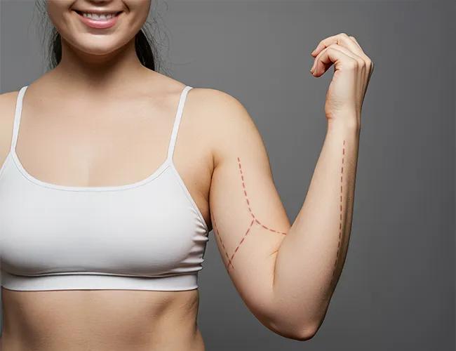 Arm Liposuction Surgery in Bangalore: A