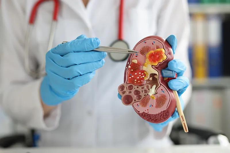 Nephrologist in Bangalore: Expert Kidney